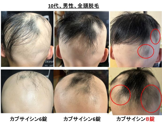 円形脱毛症　病院